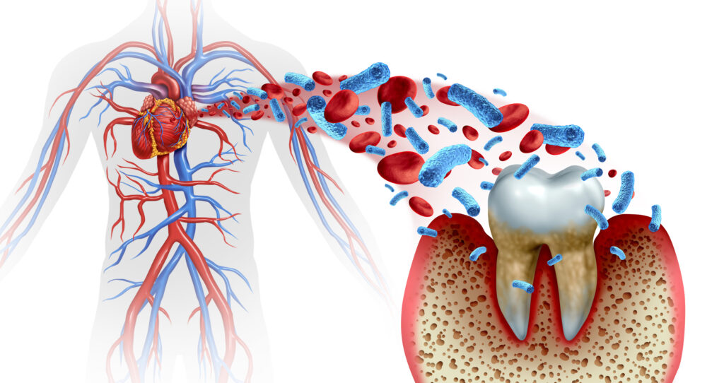 Tooth decay and heart disease as an unhealthy molar with periodontitis due to poor oral hygiene health problem as a bacteria infection in the blood as a concept with inflammation as a 3D illustration on a white background.
